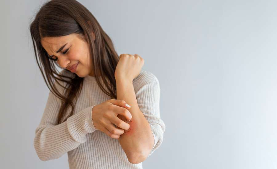 CBD et psoriasis : un soulagement naturel pour calmer démangeaisons et inflammations